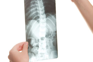 A curve you don't want. Image of a X-ray of the spine.
