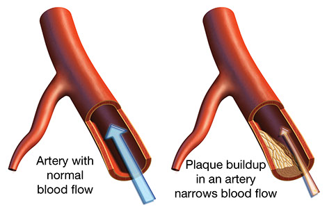 Image of an artery with normal blood flow and another with plaque buildup.