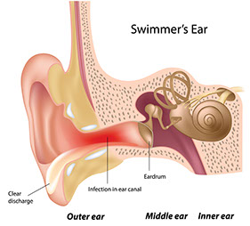 Illustration of swimmer's ear.