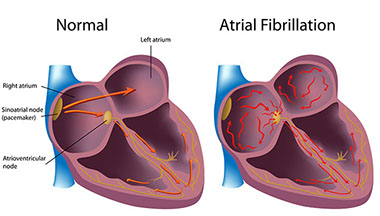 Illustration of a normal heart vs a heart with AFib.
