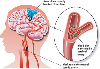 Illustration on how a stroke is caused.