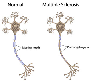 Illustration showing multiple sclerosis.
