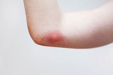 Image of arm with an insect bite mark. Image of arm with an insect bite mark.