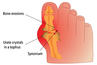 Illustration of gout.