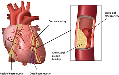 Illustration of how a heart attack is caused.