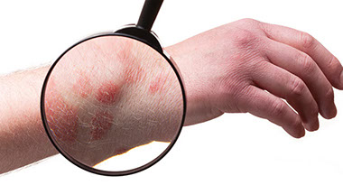 Don't be rash. Image of rash on a person's arm.
