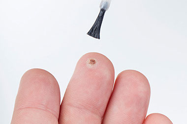 Image of medication being applied to wart on finger. Image of medication being applied to wart on finger.