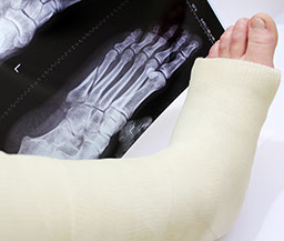 Image of broken foot.