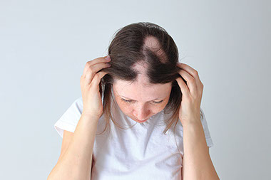 Women showing hair loss.