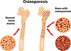 Illustration of osteoporosis.