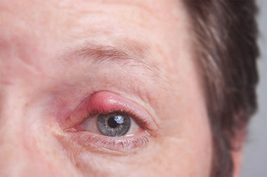 Close up image of eye with a stye.