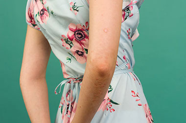Image of women's arm rash. Image of women's arm rash.