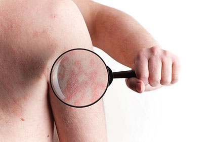 Understanding psoriasis. Close up image of psoriasis on arm.