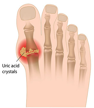 Illustration of gout.