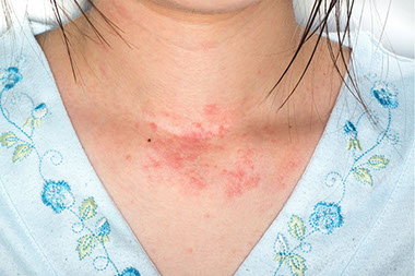 Image of a hive rash below neck. Image of a hive rash below neck.