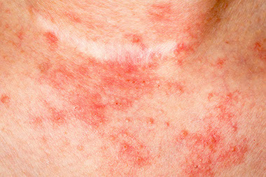 Image of an eczema rash.