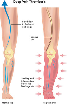 Illustration of deep vein thrombosis.