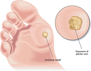 Illustration of plantar wart.