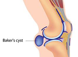 Illustration of baker's cyst.