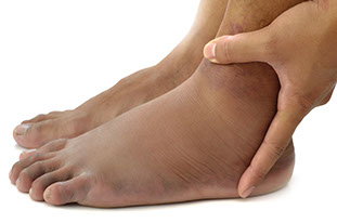 Image of swollen feet.