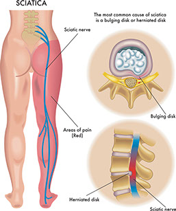 Illustration of sciatica.