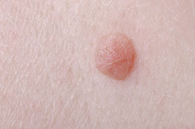 Close up image of a wart.