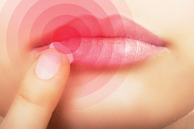 Close up image of cold sore.