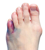 Image of a broken or sprained toe.