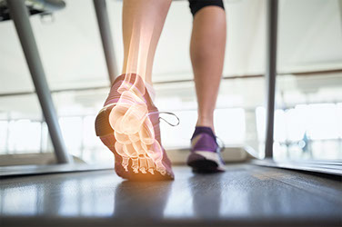 Close up of feet walking on treadmill, with an overlapping illustration of a foot skeleton.