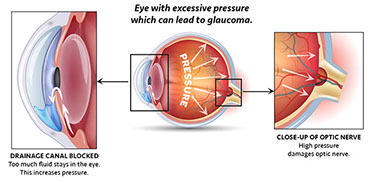 Illustration of eye with excessive pressure which can lead to glaucoma.