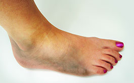 Image of broken foot bone.