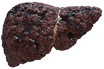 Image of liver with cirrhosis.