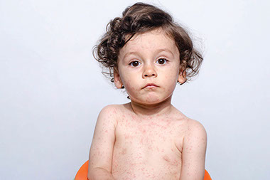 Young child with measles.