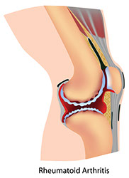 Illustration of rheumatoid arthritis.