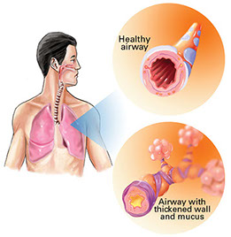 Illustration of COPD.