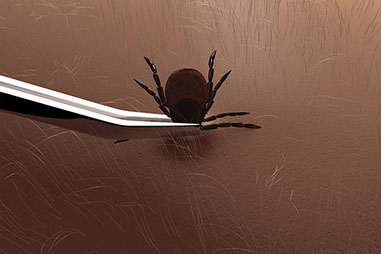 Close up image of a tick being removed from a person's skin.