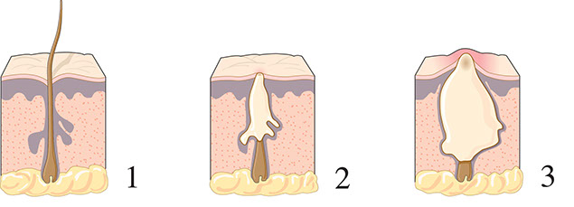 Illustration of acne forming.
