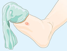 Illusration of a blister on the foot.