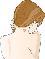 Signs of a boil. Illustration of a boil.