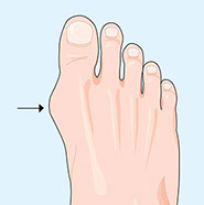 Illustration of a bunion.
