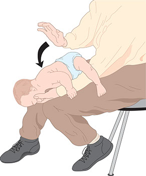 First Aid for Choking. Illustration on giving a baby first aid when choking.