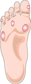 Illustration of corns and calluses on the bottom of a foot.