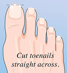Illustration on cutting toenails straight across to prevent ingrown toenails.