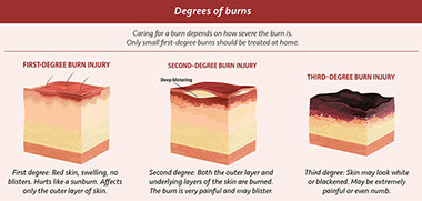 Degrees of burns. Chart of degree of burns.
