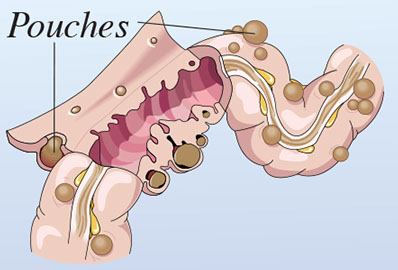 Illustration of diverticulosis in colon.