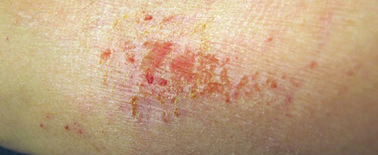 Image of eczema rash.