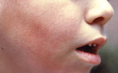 Image of fifth disease rash.