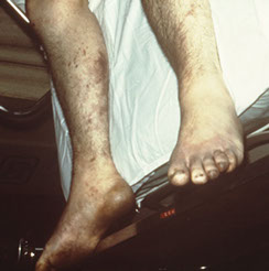 Image of gangrene.