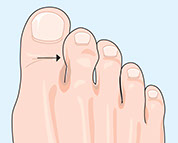Illustration of a hammertoe.