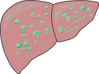 Illustration of hepatitis in the liver.